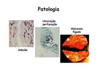 Adesão
Ulceração
perfuração
Abscesso
fígado
Patologia
 