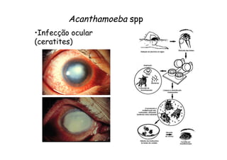 • Infecção ocular
(ceratites)
Acanthamoeba spp
 