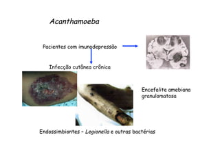 Acanthamoeba
Pacientes com imunodepressão
Encefalite amebiana
granulomatosa
Infecção cutânea crônica
Endossimbiontes – Legionella e outras bactérias
 