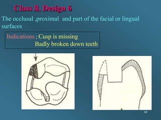 Class ll, Design 6
The occlusal ,proximal and part of the facial or lingual
surfaces
Indications ; Cusp is missing
Badly broken down teeth
60
 