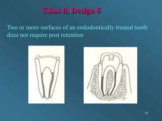 Class ll, Design 8
Two or more surfaces of an endodontically treated tooth
does not require post retention
62
 