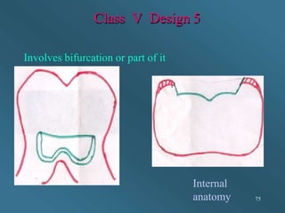 Class V Design 5
Internal
anatomy
Involves bifurcation or part of it
75
 