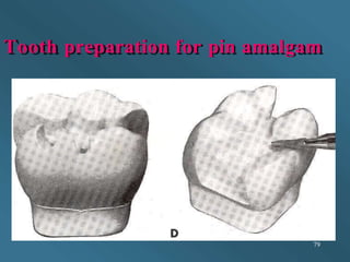 Tooth preparation for pin amalgam
79
 