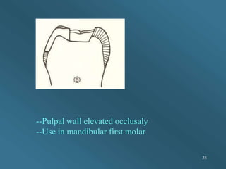 --Pulpal wall elevated occlusaly
--Use in mandibular first molar
38
 