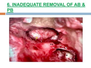 6. INADEQUATE REMOVAL OF AB &
PB
 