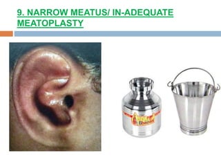 9. NARROW MEATUS/ IN-ADEQUATE
MEATOPLASTY
 