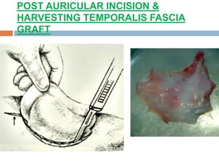 POST AURICULAR INCISION &
HARVESTING TEMPORALIS FASCIA
GRAFT
 
