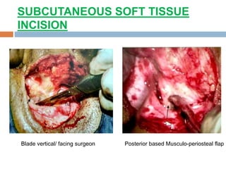 SUBCUTANEOUS SOFT TISSUE
INCISION
Blade vertical/ facing surgeon Posterior based Musculo-periosteal flap
 