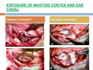 EXPOSURE OF MASTOID CORTEX AND EAR
CANAL
PRIMARY SURGERY REVISION SURGERY
 