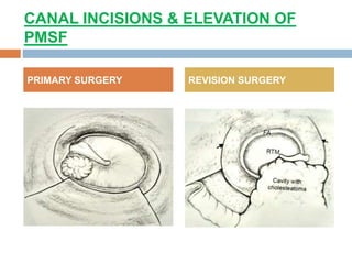 CANAL INCISIONS & ELEVATION OF
PMSF
PRIMARY SURGERY REVISION SURGERY
 