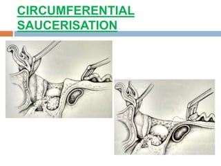 CIRCUMFERENTIAL
SAUCERISATION
 
