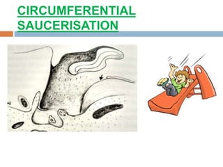 CIRCUMFERENTIAL
SAUCERISATION
 