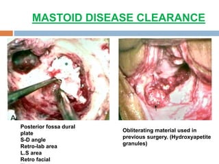 MASTOID DISEASE CLEARANCE
Posterior fossa dural
plate
S-D angle
Retro-lab area
L.S area
Retro facial
Obliterating material used in
previous surgery. (Hydroxyapetite
granules)
 