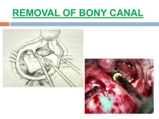 REMOVAL OF BONY CANAL
 
