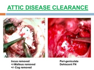 ATTIC DISEASE CLEARANCE
Incus removed
+/-Malleus removed
+/- Cog removed
Peri-geniculate
Dehiscent FN
 