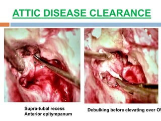 ATTIC DISEASE CLEARANCE
Supra-tubal recess
Anterior epitympanum
Debulking before elevating over OW
 