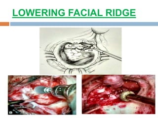 LOWERING FACIAL RIDGE
 