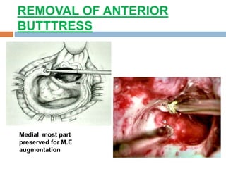 REMOVAL OF ANTERIOR
BUTTTRESS
Medial most part
preserved for M.E
augmentation
 