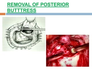 REMOVAL OF POSTERIOR
BUTTTRESS
 