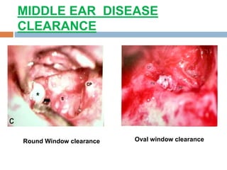 MIDDLE EAR DISEASE
CLEARANCE
Round Window clearance Oval window clearance
 