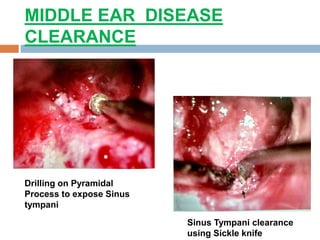 MIDDLE EAR DISEASE
CLEARANCE
Drilling on Pyramidal
Process to expose Sinus
tympani
Sinus Tympani clearance
using Sickle knife
 