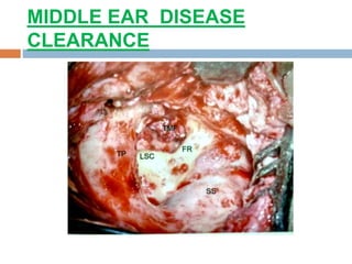 MIDDLE EAR DISEASE
CLEARANCE
 