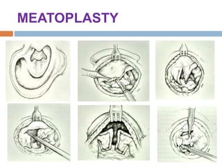 MEATOPLASTY
 