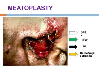 MEATOPLASTY
SMS
F
IMSF
PF
Helico-tragal
extension
 