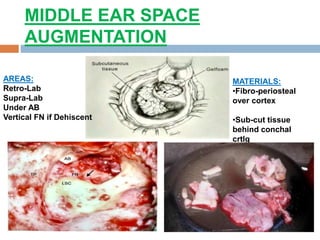 MIDDLE EAR SPACE
AUGMENTATION
AREAS:
Retro-Lab
Supra-Lab
Under AB
Vertical FN if Dehiscent
MATERIALS:
•Fibro-periosteal
over cortex
•Sub-cut tissue
behind conchal
crtlg
 