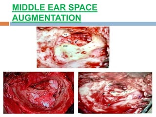 MIDDLE EAR SPACE
AUGMENTATION
 