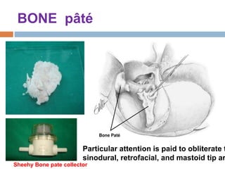 BONE pâté
Sheehy Bone pate collector
Particular attention is paid to obliterate t
sinodural, retrofacial, and mastoid tip ar
 