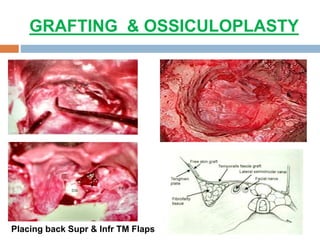 GRAFTING & OSSICULOPLASTY
Placing back Supr & Infr TM Flaps
 