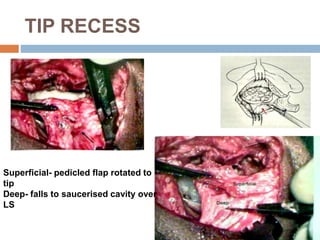 TIP RECESS
Superficial- pedicled flap rotated to
tip
Deep- falls to saucerised cavity over
LS
 