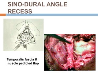 SINO-DURAL ANGLE
RECESS
Temporalis fascia &
muscle pedicled flap
 