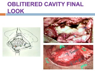 OBLITIERED CAVITY FINAL
LOOK
 