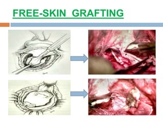 FREE-SKIN GRAFTING
 