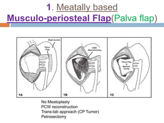 1. Meatally based
Musculo-periosteal Flap(Palva flap)
No Meatoplasty
PCW reconstruction
Trans-lab approach (CP Tumor)
Petrosectomy
 