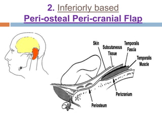 2. Inferiorly based
Peri-osteal Peri-cranial Flap
 