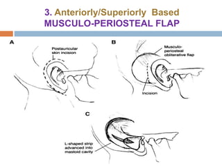 3. Anteriorly/Superiorly Based
MUSCULO-PERIOSTEAL FLAP
 