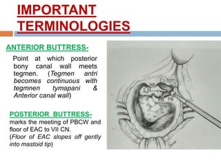 IMPORTANT
TERMINOLOGIES
ANTERIOR BUTTRESS-
Point at which posterior
bony canal wall meets
tegmen. (Tegmen antri
becomes continuous with
tegmnen tymapani &
Anterior canal wall)
POSTERIOR BUTTRESS-
marks the meeting of PBCW and
floor of EAC to VII CN.
(Floor of EAC slopes off gently
into mastoid tip)
 