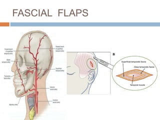 FASCIAL FLAPS
 