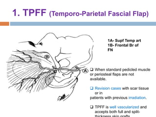1. TPFF (Temporo-Parietal Fascial Flap)
1A- Supf Temp art
1B- Frontal Br of
FN
 When standard pedicled muscle
or periosteal flaps are not
available.
 Revision cases with scar tissue
or in
patients with previous irradiation.
 TPFF is well vascularized and
accepts both full and split-
 