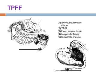 TPFF
(1) Skin/subcutaneous
tissue
(2) TPFF
(3) loose areolar tissue
(4) temporalis fascia
(5) temporalis muscle.
 