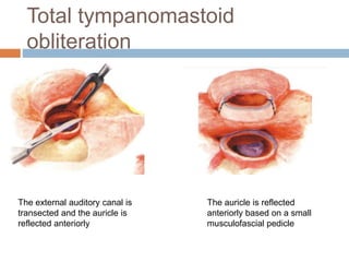 Total tympanomastoid
obliteration
The external auditory canal is
transected and the auricle is
reflected anteriorly
The auricle is reflected
anteriorly based on a small
musculofascial pedicle
 