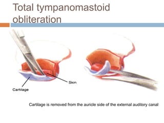 Total tympanomastoid
obliteration
Cartilage is removed from the auricle side of the external auditory canal
 
