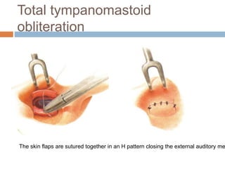 Total tympanomastoid
obliteration
The skin flaps are sutured together in an H pattern closing the external auditory me
 