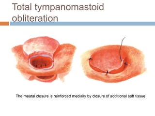 Total tympanomastoid
obliteration
The meatal closure is reinforced medially by closure of additional soft tissue
 