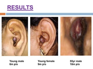 RESULTS
Young male
6m p/o
Young female
9m p/o
55yr male
18m p/o
 