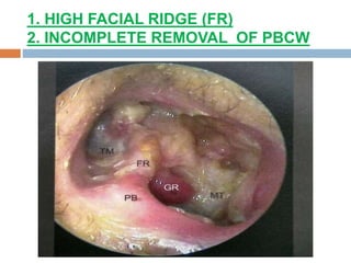 1. HIGH FACIAL RIDGE (FR)
2. INCOMPLETE REMOVAL OF PBCW
 