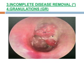 3.INCOMPLETE DISEASE REMOVAL (*)
4.GRANULATIONS (GR)
 